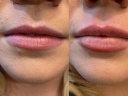 Botox injections in cheltenham, spray tans hatherley, botox cheltenham, lip fillers cheltenham dermal fillers