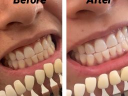 Wrinkle reduction Cheltenham, Glowing skin Cheltenham, Non-surgical facial treatments Cheltenham, Anti-ageing treatments Cheltenham, Skin tightening Cheltenham Teeth whitening Cotswolds