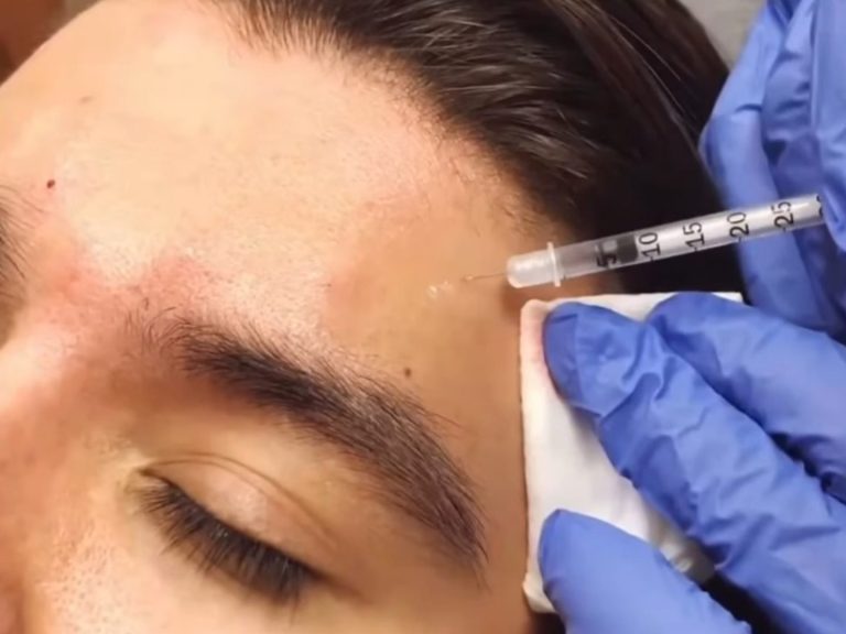 Botox treatment Cheltenham, facials cheltenham, weight injections cheltenham, mounjaro cheltenham, forehead botox cheltenham Botox injections Gloucester