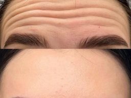 Best spray tans in cheltenham, Lip filler in Cheltenham, Botox in Cheltenham, chemical peels in Cheltenham, aesthetics clinic in Cheltenham Spray tans in Cheltenham