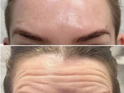 Mounjaro Cotswolds, aesthetics clinic cheltenham, aesthetics Cotswolds, frown line treatment cheltenham, facial rejuvenation cotswolds Botox Cheltenham