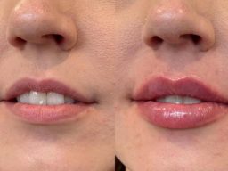 Micro-needling treatments cheltenham, fillers in cheltenham, botox near me, spray tan near me Botox in cheltenham