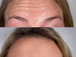 Botox in Cheltenham, botox Cheltenham, anti-wrinkle treatment Cheltenham, aesthetic treatments Cheltenham, cosmetic clinic Cheltenham , skin care Cheltenham , beauty treatments Gloucestershire, non-surgical procedures UK anti-wrinkle injections Cheltenham