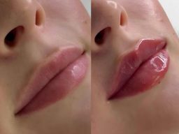 lip fillers Cotswolds, Cheltenham Aesthetics Clinic, cheek augmentation cheltenham, vitamin injections in cheltenham lip fillers cheltenham