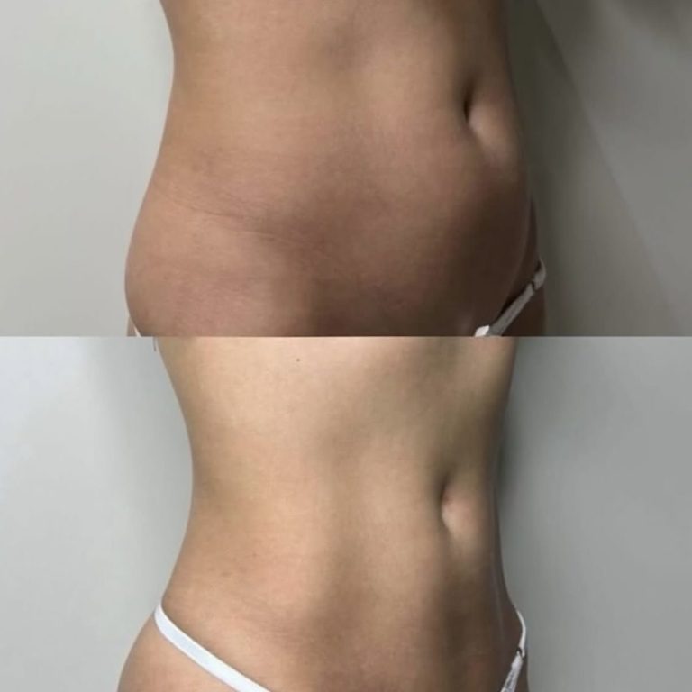 fat dissolving injections Cheltenham, botox treatments Cheltenham, anti-wrinkle injections Cheltenham, facial rejuvenation Cheltenham , B12 vitamin injections Cheltenham, energy boost B12 shots Gloucestershire Fat dissolvant treatments Cheltenham